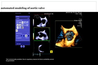automated modeling of aortic valve
*Not commercially available. Due to regulatory reasons its future availability cannot
be guaranteed.
 