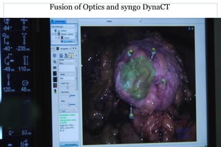 Fusion of Optics and syngo DynaCT
 