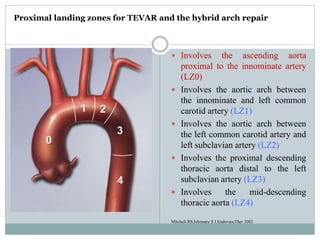  Involves the ascending aorta
proximal to the innominate artery
(LZ0)
 Involves the aortic arch between
the innominate a...