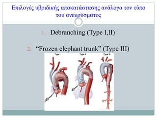 Επιλογές υβριδικής αποκατάστασης ανάλογα τον τύπο
του ανευρύσματος
1. Debranching (Type I,II)
2. “Frozen elephant trunk” (...