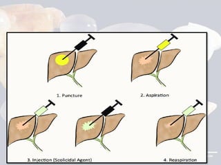 Hydid hydatid CLINICAL PICTURE AND TREATMENT.pptx