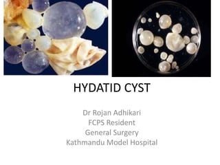 HYDATID CYST
Dr Rojan Adhikari
FCPS Resident
General Surgery
Kathmandu Model Hospital
 