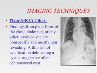 IMAGING TECHNIQUES
• Plain X-RAY Films:
• Findings from plain films of
the chest, abdomen, or any
other involved site are
nonspecific and mostly non
revealing. A thin rim of
calcification delineating a
cyst is suggestive of an
echinococcal cyst.
 