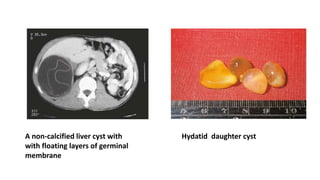 A non-calcified liver cyst with
with floating layers of germinal
membrane
Hydatid daughter cyst
 