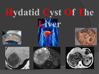 Hydatid Cyst Of The
Liver
 