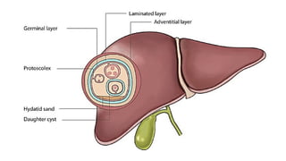 Hydid Hydatid Cyst: Pathogenesis, Clinical Manifestations, and Management ...