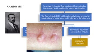 Induration Cyst Hydatid Cyst: Pathogenesis, Clinical Manifestations, and Management ...
