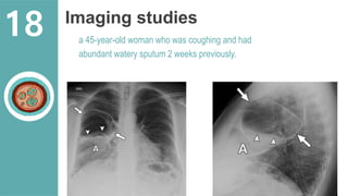 Imaging studies
a 45-year-old woman who was coughing and had
abundant watery sputum 2 weeks previously.
18
 