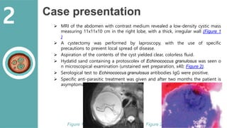 Case presentation
 MRI of the abdomen with contrast medium revealed a low-density cystic mass
measuring 11x11x10 cm in the right lobe, with a thick, irregular wall (Figure 1
)
 A cystectomy was performed by laproscopy, with the use of specific
precautions to prevent local spread of disease.
 Aspiration of the contents of the cyst yielded clear, colorless fluid.
 Hydatid sand containing a protoscolex of Echinococcus granulosus was seen o
n microscopical examination (unstained wet preparation, x40; Figure 2).
 Serological test to Echinococcus granulosus antibodies IgG were positive.
 Specific anti-parasitic treatment was given and after two months the patient is
asymptomatic.
2
Figure 1 Figure 2
 