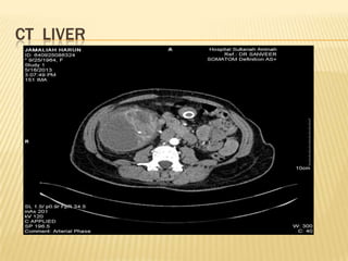 CT LIVER
 
