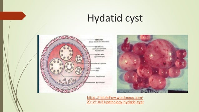 Hydatid disease