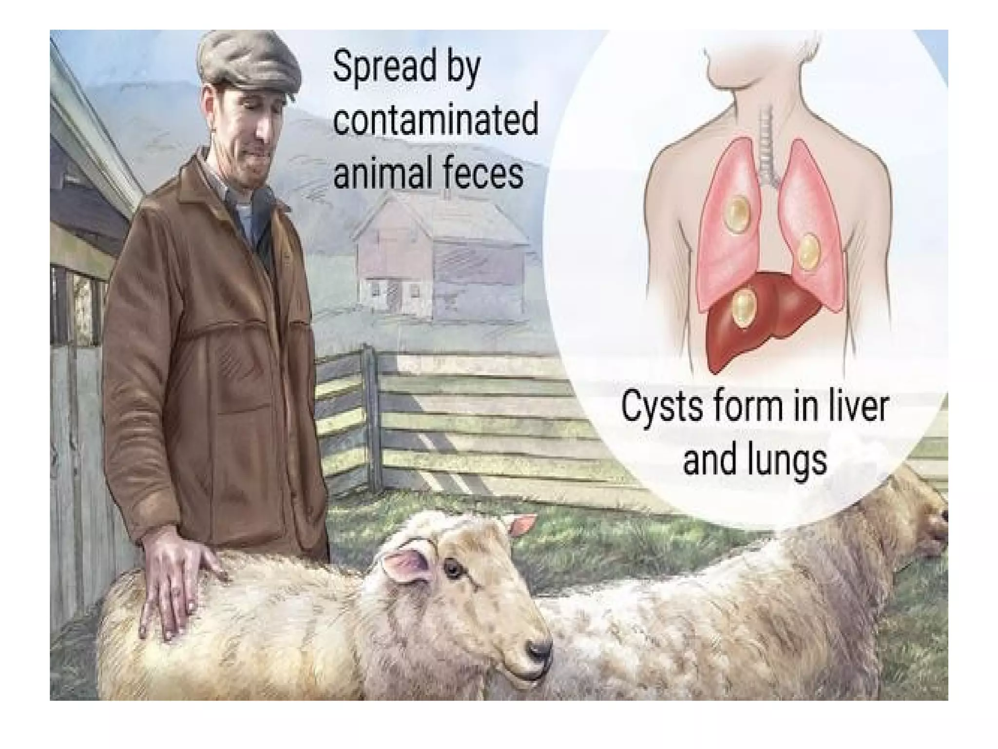 Hydatid disease | PPT