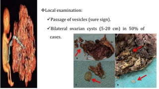 Local examination:
Passage of vesicles (sure sign).
Bilateral ovarian cysts (5-20 cm) in 50% of
cases.
 