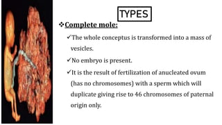 TYPES
Complete mole:
The whole conceptus is transformed into a mass of
vesicles.
No embryo is present.
It is the result of fertilization of anucleated ovum
(has no chromosomes) with a sperm which will
duplicate giving rise to 46 chromosomes of paternal
origin only.
 