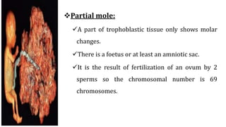 Partial mole:
A part of trophoblastic tissue only shows molar
changes.
There is a foetus or at least an amniotic sac.
It is the result of fertilization of an ovum by 2
sperms so the chromosomal number is 69
chromosomes.
 