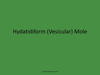 Hydatidiform (Vesicular) Mole www.freelivedoctor.com 