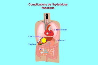 Complications de l’hydatidose
         hépatique




                       D is s é m in a tio n


C o m p r e s s io n
                            In fe c tio n
R u p tu re
 