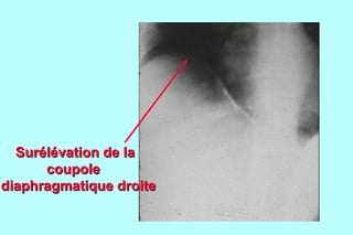 Surélévation de la
      coupole
diaphragmatique droite
 