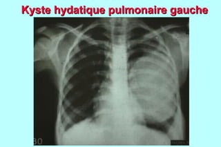 Kyste hydatique pulmonaire gauche
 