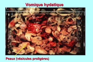 Vomique hydatique




Peaux (vésicules proligères)
 