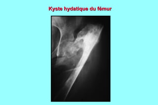 Kyste hydatique du fémur
 