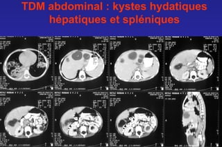 TDM abdominal : kystes hydatiques
    hépatiques et spléniques
 