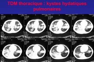 TDM thoracique : kystes hydatiques
          pulmonaires
 