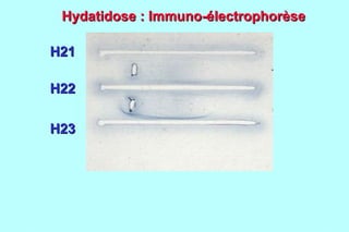 Hydatidose : Immuno-électrophorèse

H21

H22

H23
 