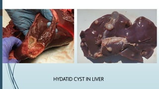 HYDATID CYST IN LIVER
 