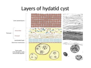 HYDATID cyst of liver causes investigatio and management.pptx