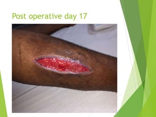 Post operative day 17
 
