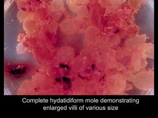 Complete hydatidiform mole demonstrating
enlarged villi of various size
 