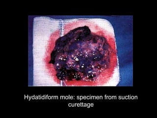 Hydatidiform mole: specimen from suction
curettage
 