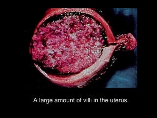 A large amount of villi in the uterus.
 