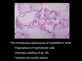The microscopic appearance of hydatidiform mole:
•Hyperplasia of trophobasitc cells
•Hydropic swelling of all villi
•Vessles are usually absent
 