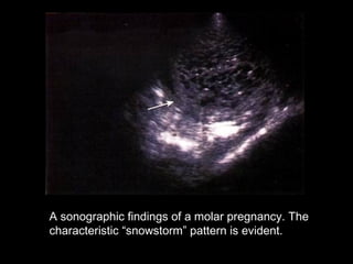 A sonographic findings of a molar pregnancy. The
characteristic “snowstorm” pattern is evident.
 