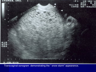 Transvaginal sonogram demonstrating the “ snow storm” appearance.
 