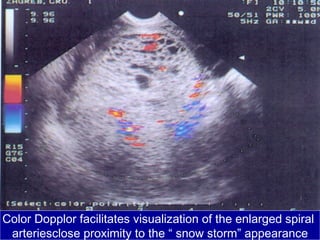Color Dopplor facilitates visualization of the enlarged spiral
arteriesclose proximity to the “ snow storm” appearance
 