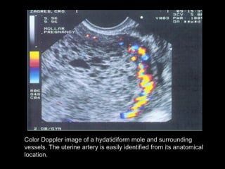 Color Doppler image of a hydatidiform mole and surrounding
vessels. The uterine artery is easily identified from its anatomical
location.
 