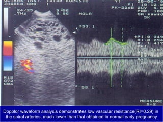 Dopplor waveform analysis demonstrates low vascular resistance(RI=0.29) in
the spiral arteries, much lower than that obtained in normal early pregnancy
 