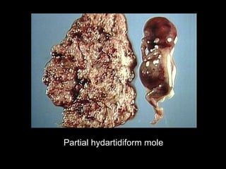 Partial hydartidiform mole
 