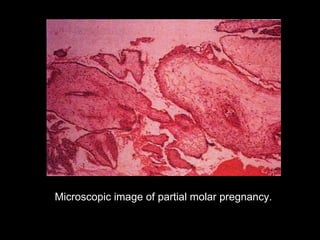 Microscopic image of partial molar pregnancy.
 