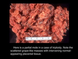 Here is a partial mole in a case of triploidy. Note the
scattered grape-like masses with intervening normal-
appearing placental tissue.
 