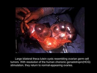 Large bilateral theca lutein cysts resembling ovarian germ cell
tumors. With resolution of the human chorionic gonadotropin(HCG)
stimulation, they return to normal-appearing ovaries.
 