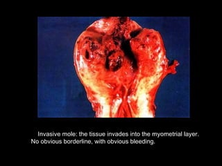 Invasive mole: the tissue invades into the myometrial layer.
No obvious borderline, with obvious bleeding.
 