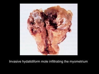 Invasive hydatidiform mole infiltrating the myometrium
 