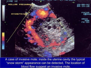 A case of invasive mole: inside the uterine cavity the typicalA case of invasive mole: inside the uterine cavity the typical
““snow stormsnow storm”” appearance can be detected, The location ofappearance can be detected, The location of
blood flow suggest an invasive mole.blood flow suggest an invasive mole.
 