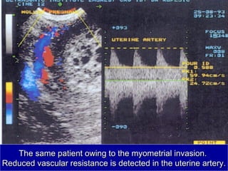 The same patient owing to the myometrial invasion.The same patient owing to the myometrial invasion.
Reduced vascular resistance is detected in the uterine artery.Reduced vascular resistance is detected in the uterine artery.
 
