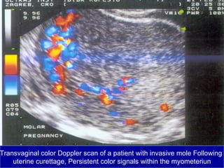 Transvaginal color Doppler scan of a patient with invasive mole Following
uterine curettage, Persistent color signals within the myometeriun
 