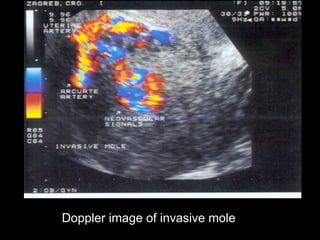 Doppler image of invasive mole
 